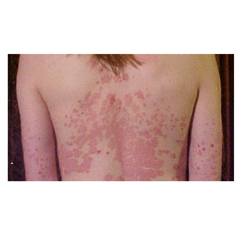 erythrodermic psoriasis