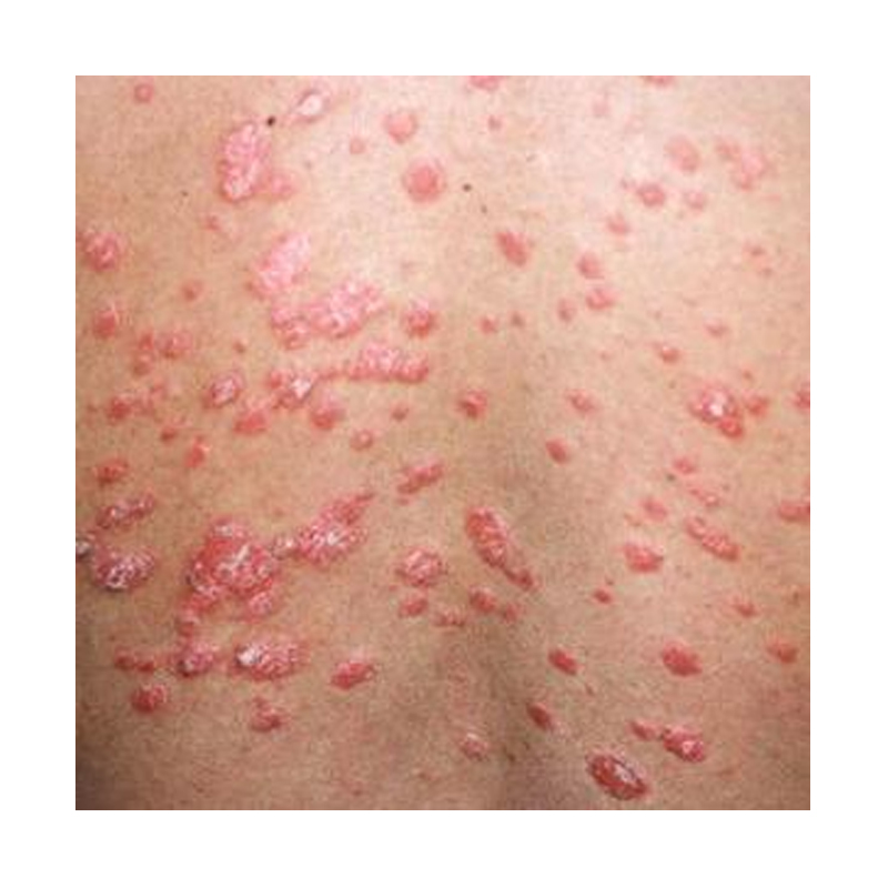 guttat psoriasis