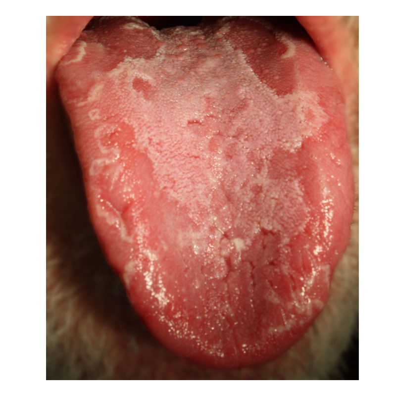 Mouth psoriasis