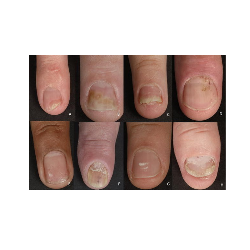 Nail psoriasis