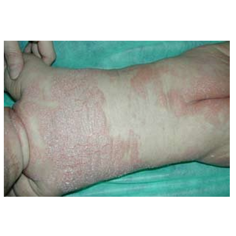 Napkin psoriasis