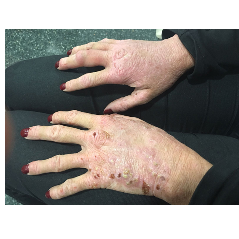 Pustular psoriasis