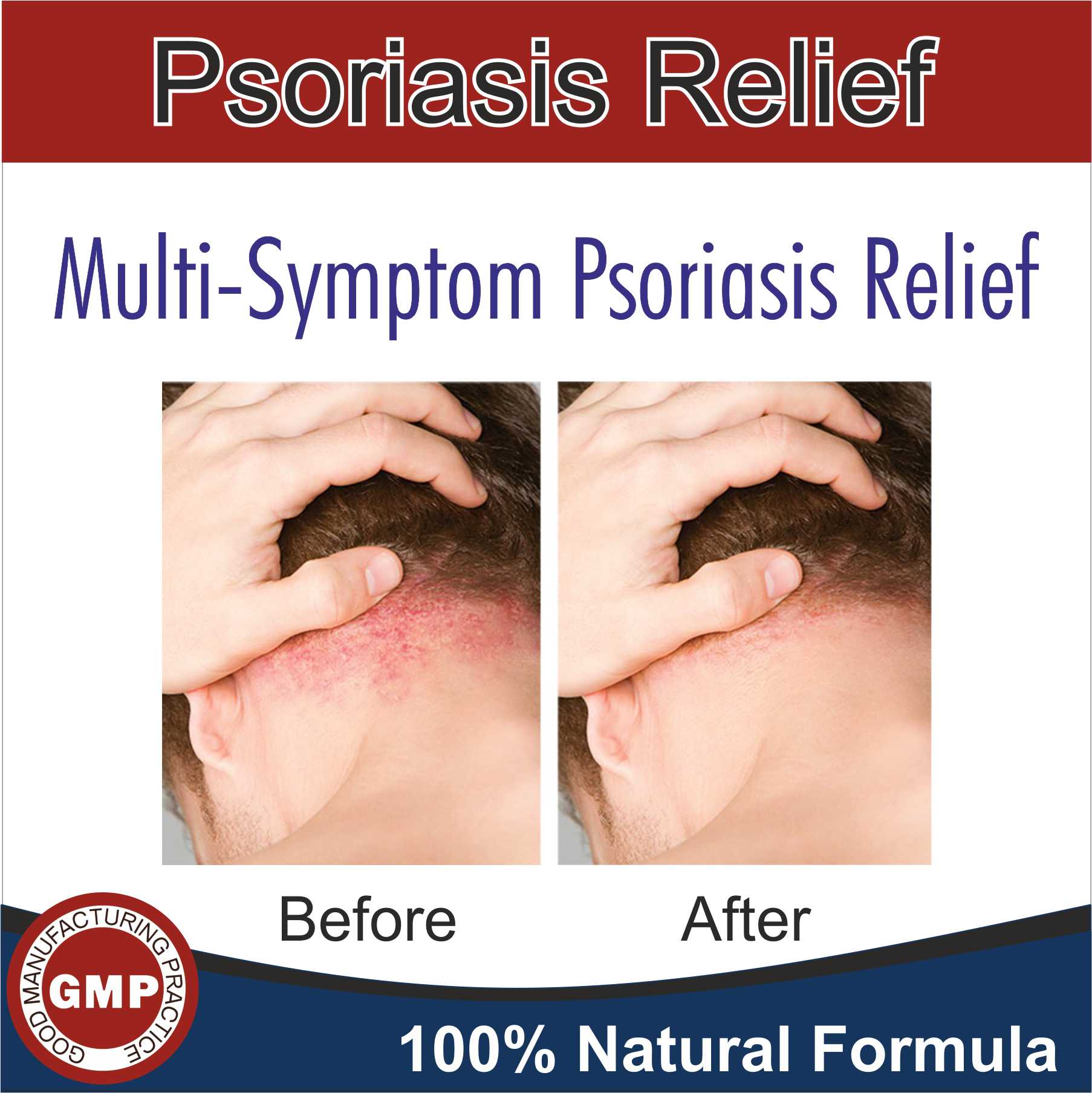 Psoriasis Herbal Medicine, Cure Psoriasis with Ayurveda, Shree Natural Remedies